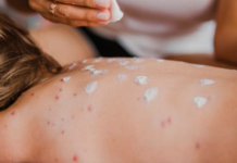 México suma casi 14 mil casos de sarampión; ¿cuál es el estado con más contagios?