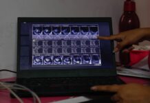 Cáncer de colon es cada vez más frecuente en México: expertos