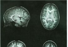 Así afecta la adicción a Internet a un cerebro adolescente, según un estudio